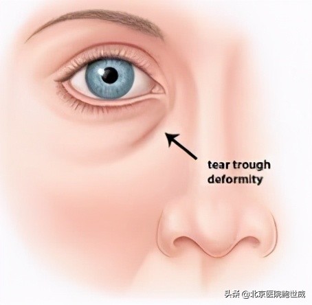 泪沟严重显老怎么办,泪沟显老的地方