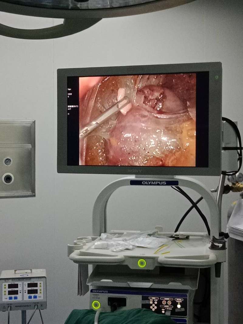 肾囊肿微创引流术,腹腔镜下肾囊肿去顶术为几类切口