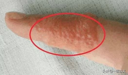 手指长小水泡瘙痒汗疱疹怎么治疗,手指夏天长小疱疹痒