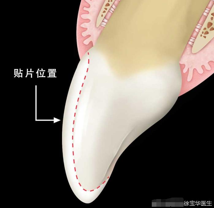 烤瓷牙贴片全口价格,贴片牙齿和烤瓷牙有哪些伤害