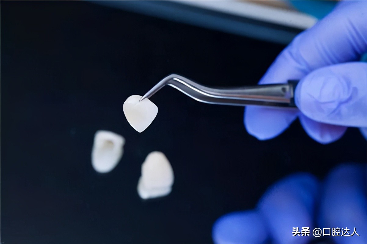 牙缝大是牙冠矫正还是贴面,牙齿贴面补牙缝多少钱