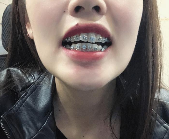 牙套隐形日记,牙套日记正颌