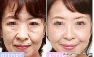 才20岁脸上有皱纹咋回事,才20岁就有皱纹了怎么办