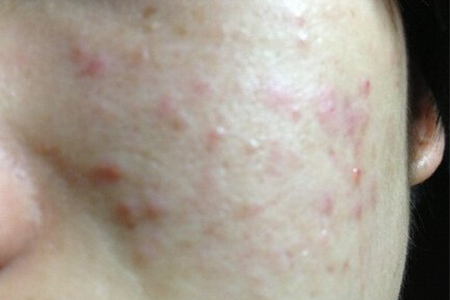 下巴不停冒脓包型痘痘怎么样调理,青春期脸上长脓包型痘痘怎么治疗