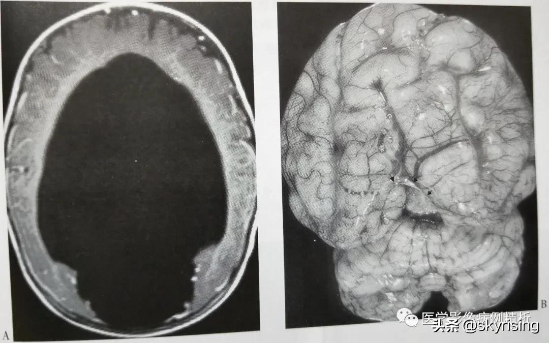 半叶全前脑畸形,无叶型前脑无裂畸形超声表现