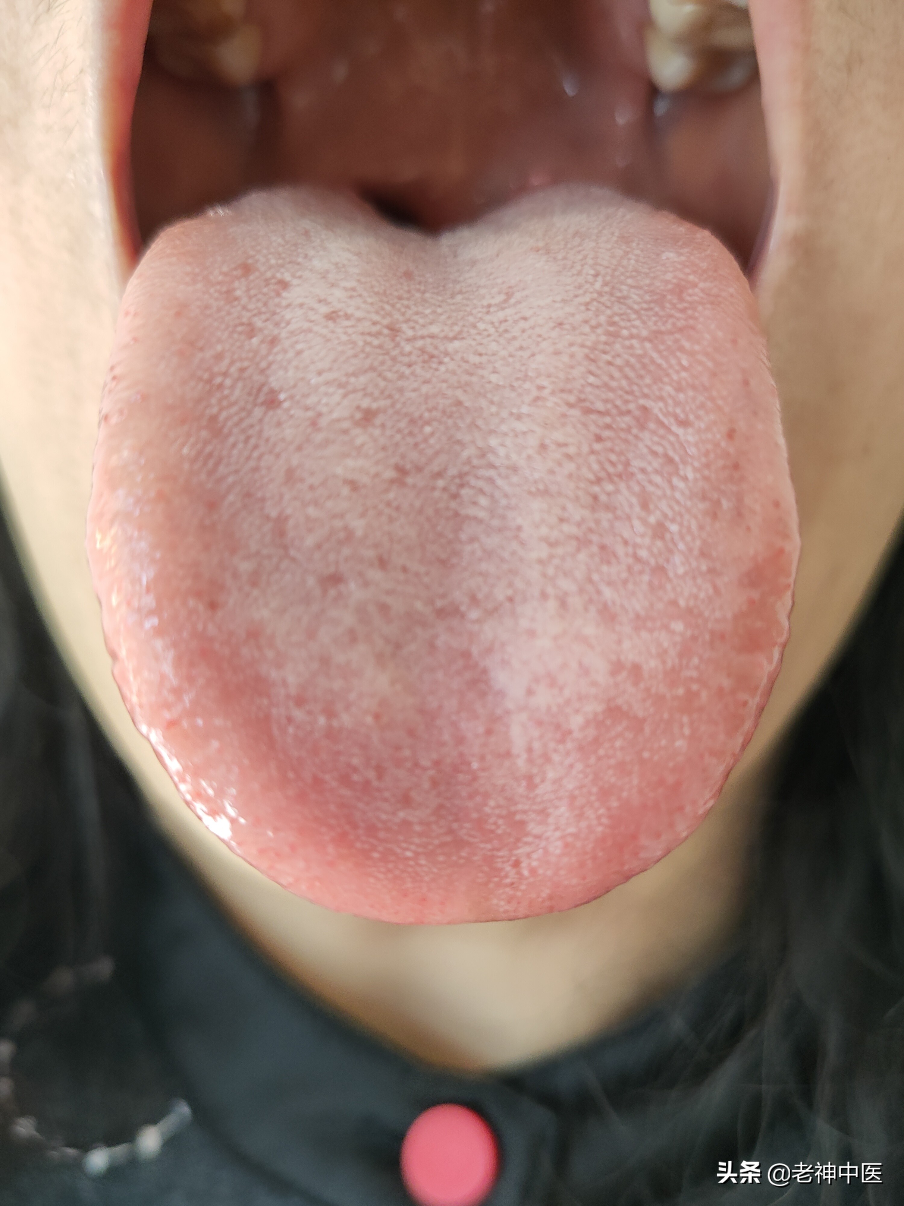 顽固性荨麻疹中医疗法,麻疹反反复复最快治疗方法