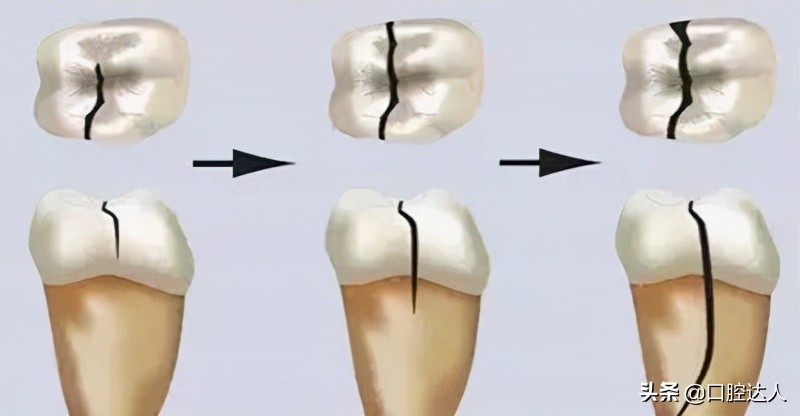 牙齿用光照有裂纹,光透过牙齿有裂纹