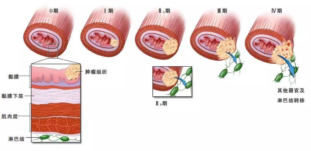 食管癌是烫出来的吗,食管癌是不是烫出来的