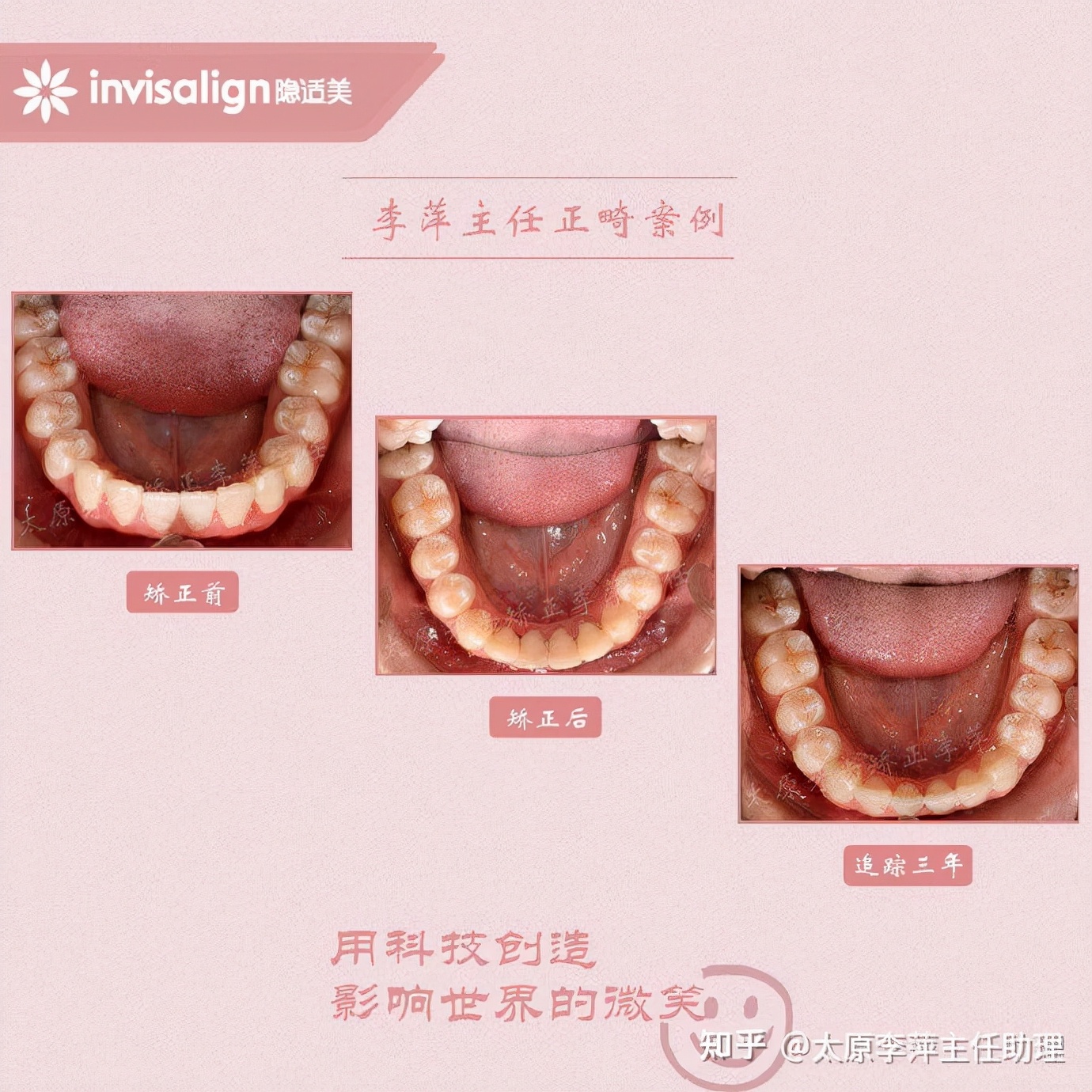 太原市牙齿正畸,太原市口腔正畸