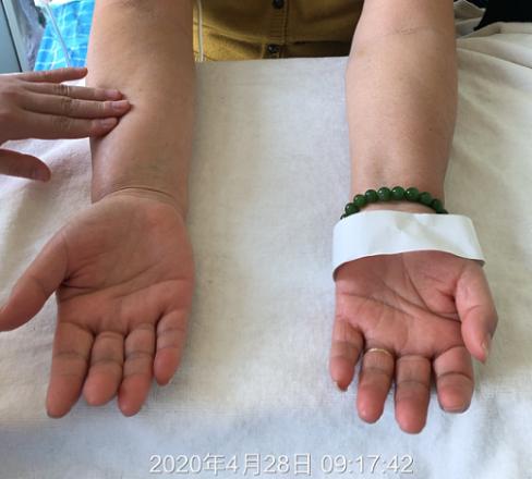 留置picc需要什么医嘱,picc静脉置管能随时拔除