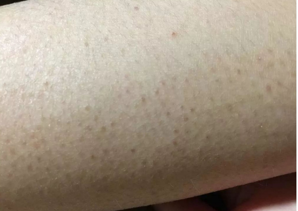 科普微针祛痘,消炎修复和祛痘