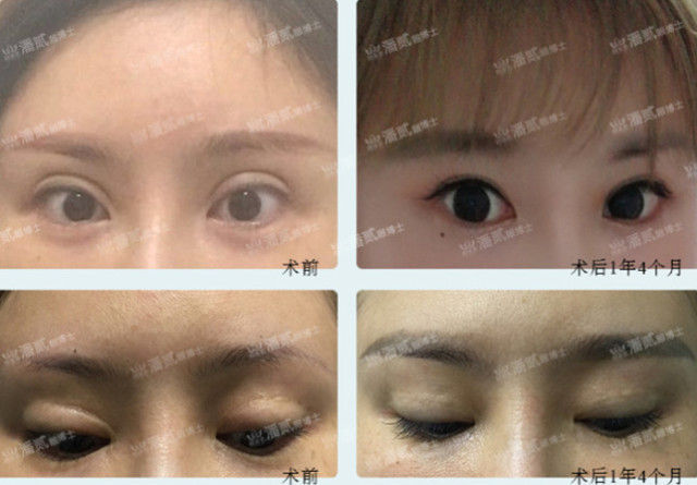 欧式大双眼皮和平行双眼皮,醒醒吧明智的放弃胜过盲目的执着