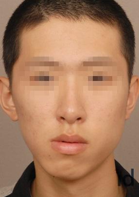 国字脸打瘦脸针有什么副作用吗,打瘦脸针有没有副作用和后遗症