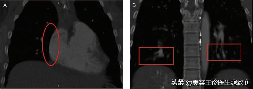 私密填充手术效果怎么样,阴道整形手术一般多久能恢复
