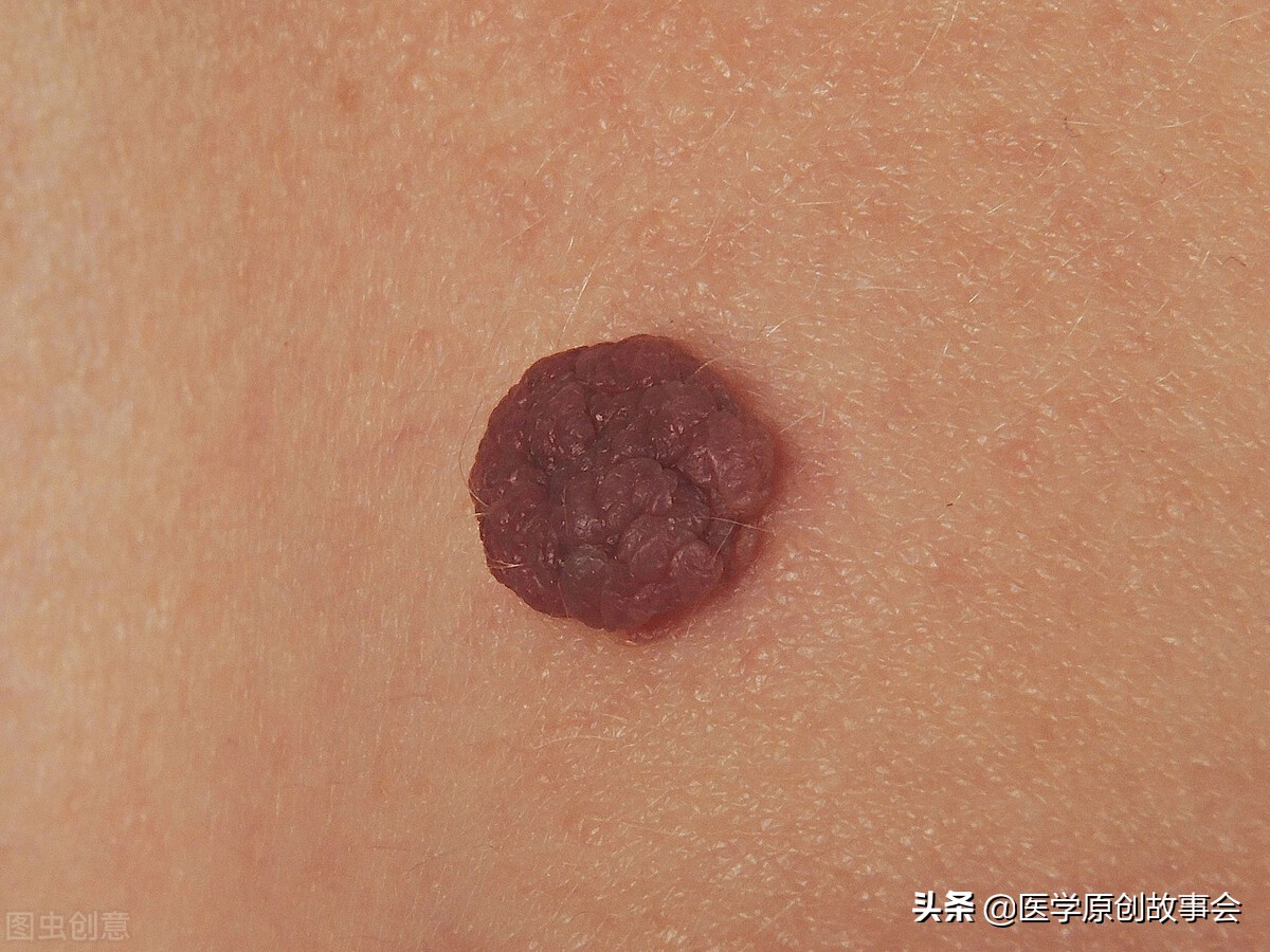 皮肤长了个凸起的小肉球怎么去除,皮肤表面长出小肉球是什么原因呢