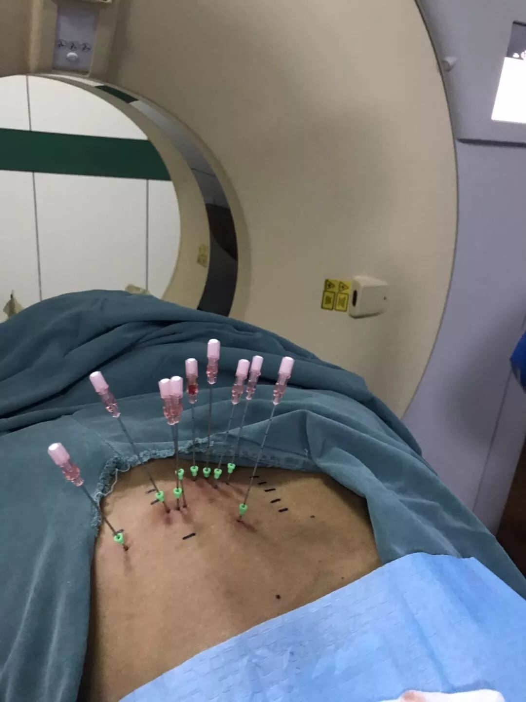 晚期肺癌患者,应用粒子植入术,抗癌案例分享