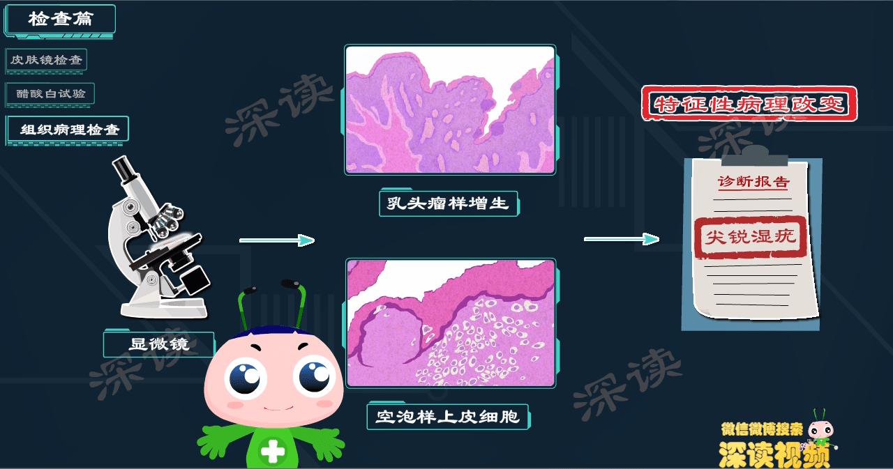 液氮冷冻治疗尖锐疣疼吗 (液氮冷冻治疗尖锐疣几天掉)