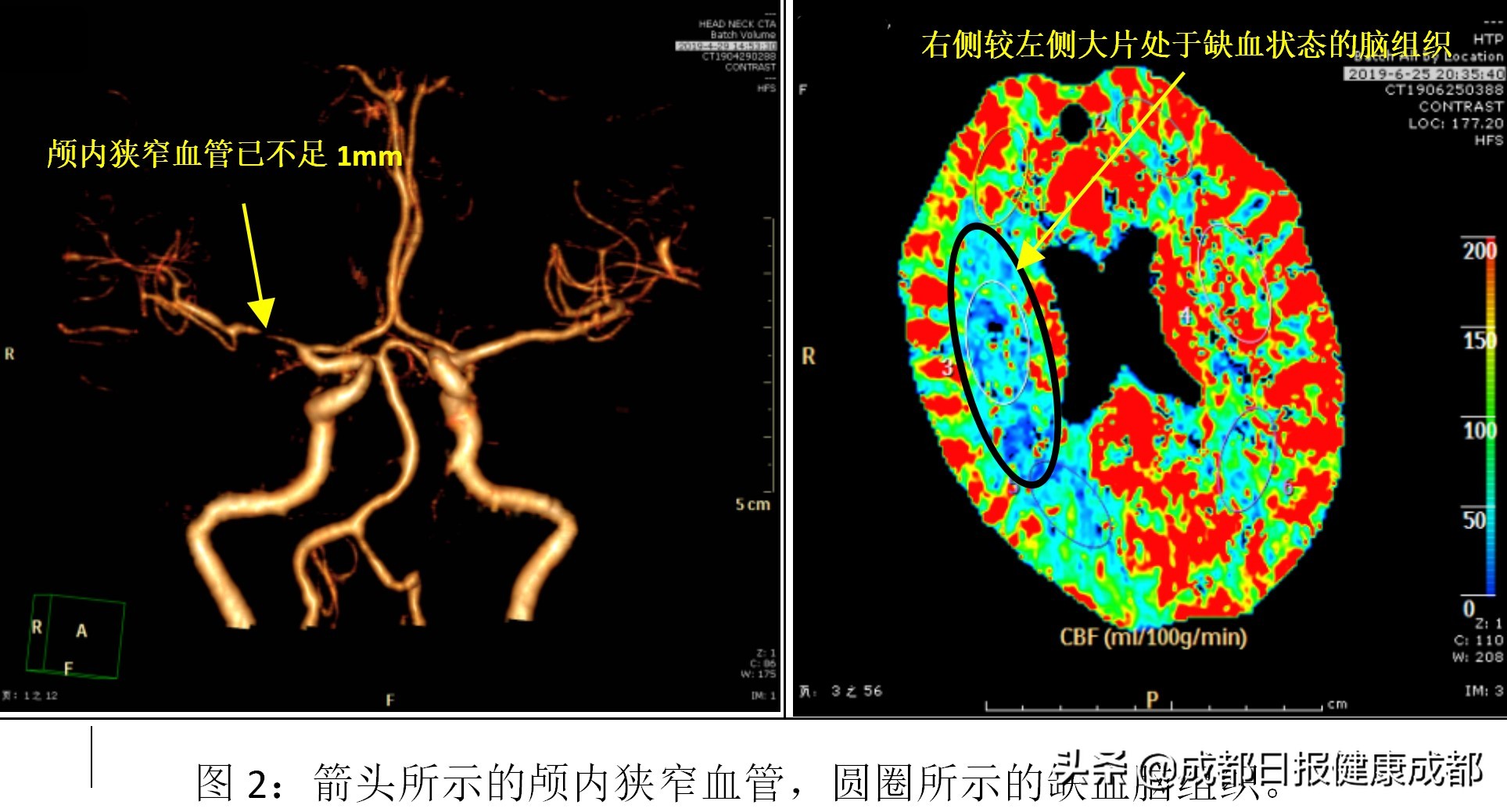 如何控制脑血管中风,脑血管堵了三根做搭桥还是支架