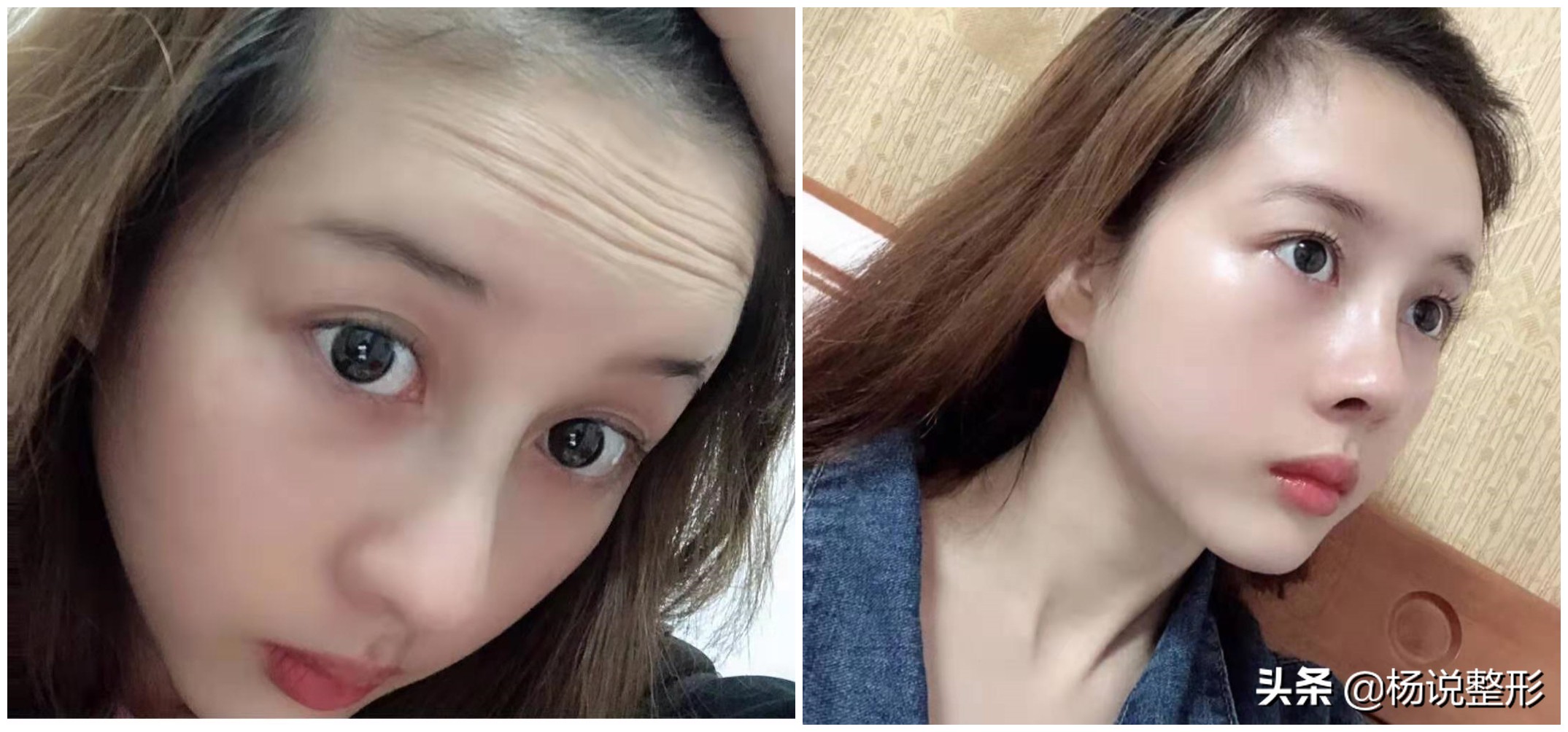 9种祛皱纹方法,除皱4招轻松应对脸部皱纹