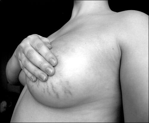 难看又难缠的肥胖纹，要如何预防和去除呢？