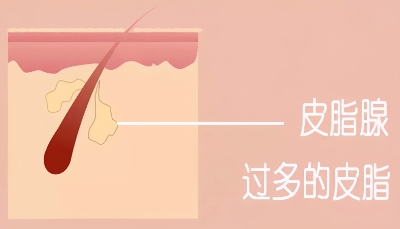 激光祛黑头真的可以去除吗,激光治疗黑头毛孔粗大多少钱