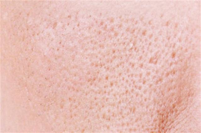 毛孔粗大皮肤粗糙怎么办,男生毛孔粗大毛孔粗糙怎么办
