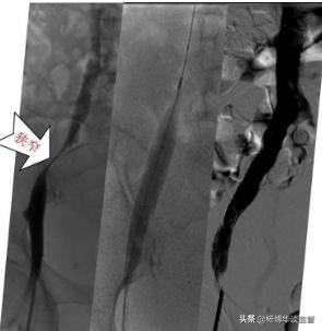 突然出现腿肿一定要当心,腿肿有小红点是什么原因