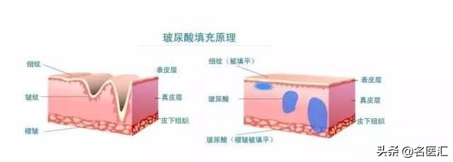 玻尿酸的作用与危害打了要肿几天,玻尿酸补水修护精华液的功效作用