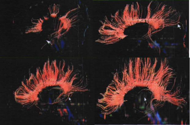 磁共振成像mri的基本原理,磁共振后dti怎么处理