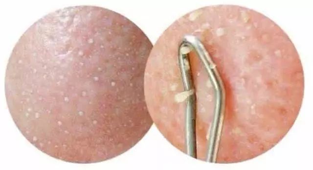 腋下痘痘挤出白色米粒是什么,痘痘里面挤出小米粒是不是就好了