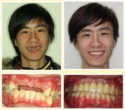 后槽牙缺失不想种植还有什么方法,牙齿缺失的修复方式有哪些