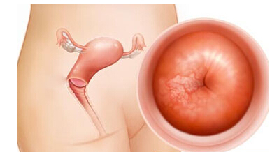 宫颈炎症引起的什么癌,宫颈癌细胞病变