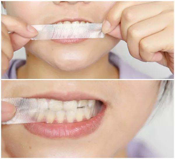 牙齿美白最好的技术,口腔牙齿美白