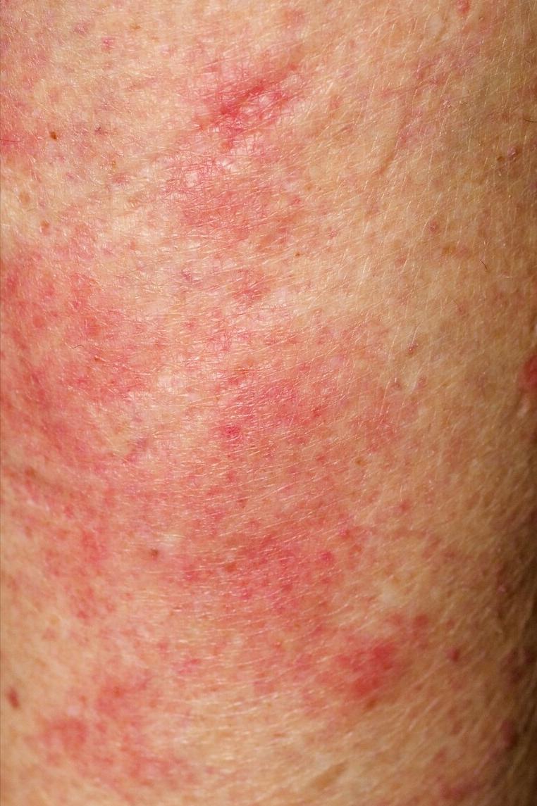 中医治疗荨麻疹怎么才可以治断根,中医麻疹最早期的诊断