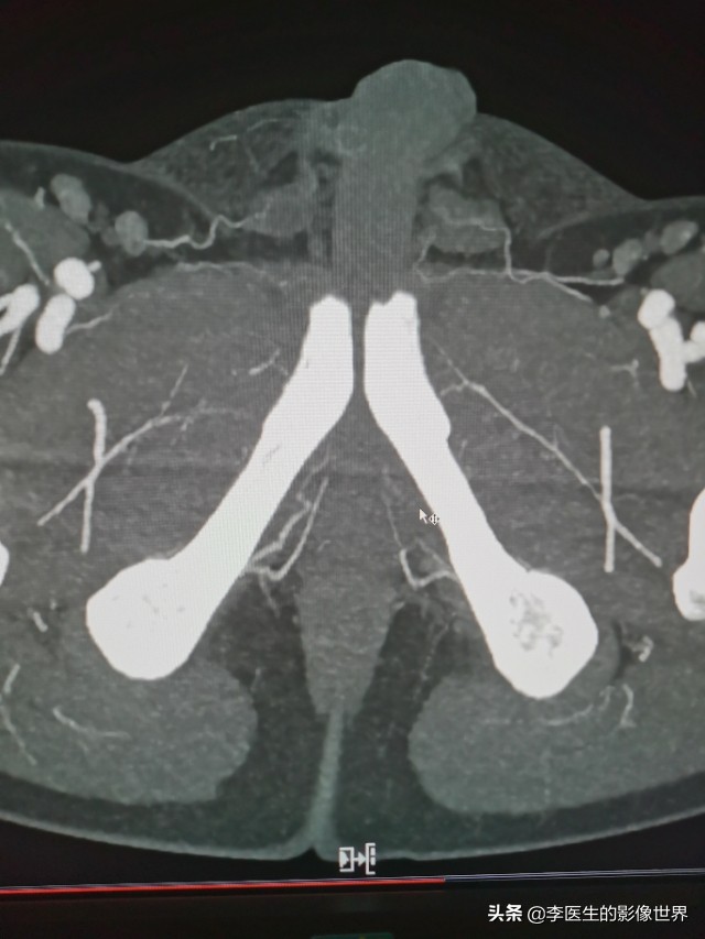 勃起功能障碍,ED之阴部内动脉CT血管成像