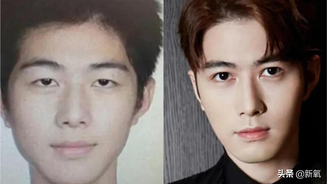 做双眼皮的姐妹还是要慎重,姐妹们你们割双眼皮多少钱