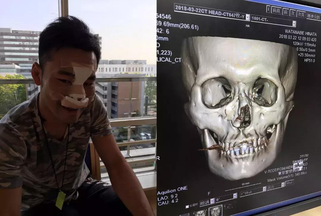 泰拳王江通猜个人集锦,泰拳王江通猜的技术特点