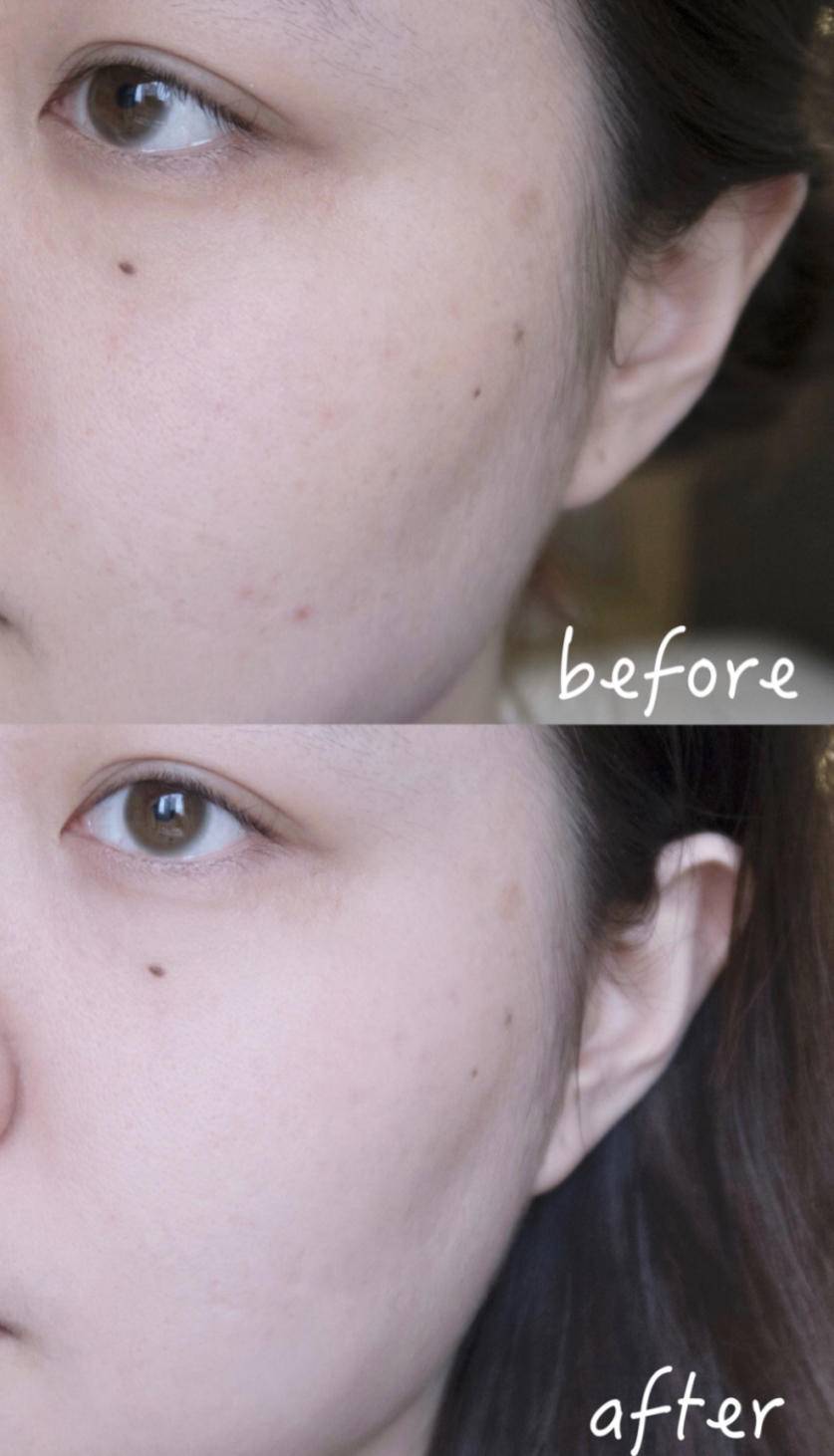 痘痘痘印的正确处理方法,痘痘留下的痘印应如何正确处理