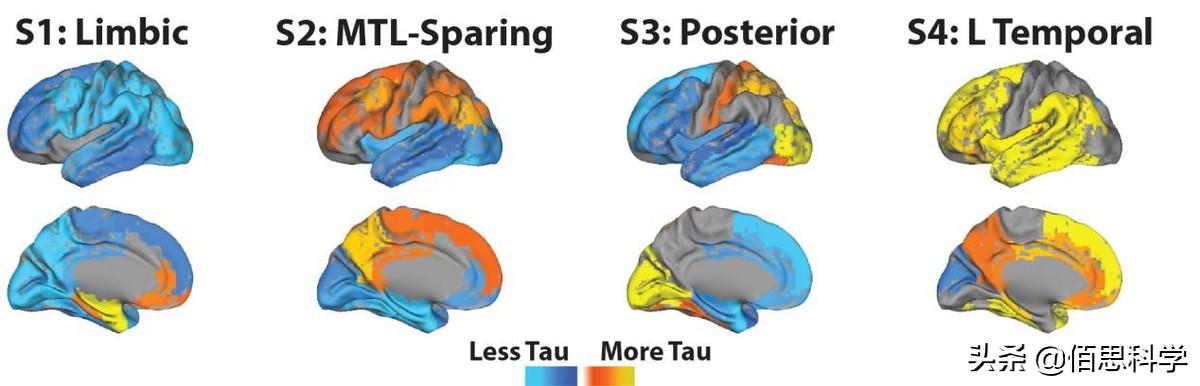 阿兹海默症跟失智症一样吗,阿兹海默病是帕金森吗