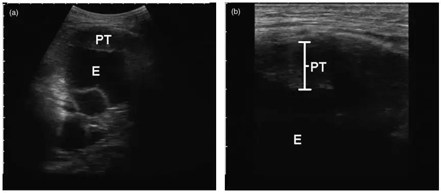 胸部超声引导下穿刺活检术流程,ct引导下肺穿刺活检优缺点