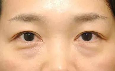 祛除大眼袋黑眼圈皱纹色斑痘痘,怎样祛除黑眼圈眼袋的方法