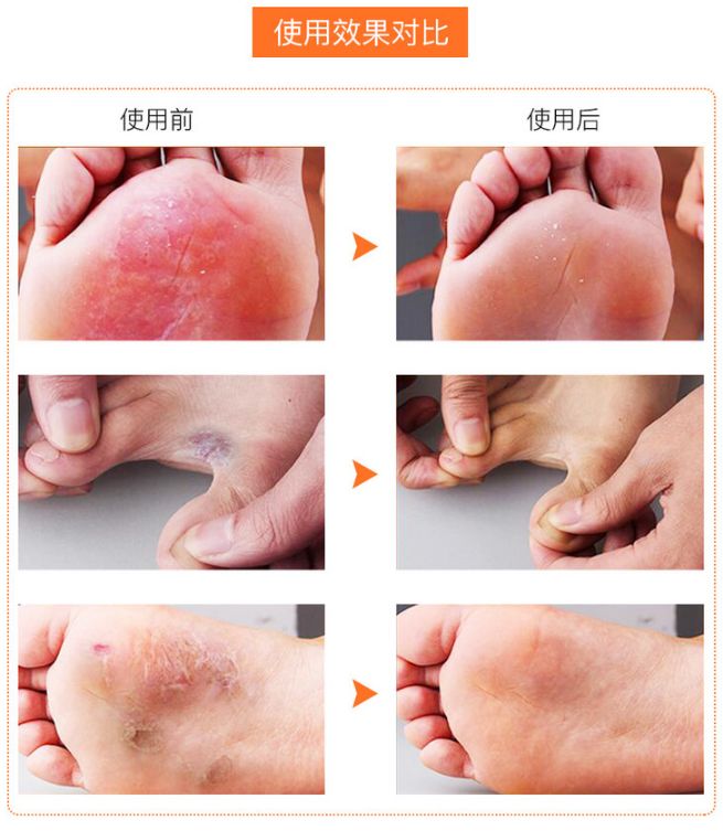 脚气脚臭脚痒的克星用什么,用什么泡脚可以治愈脚气