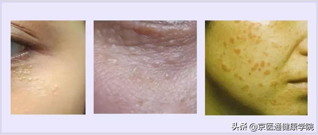 粟丘疹汗管瘤扁平疣区别,粟丘疹和汗管瘤区别