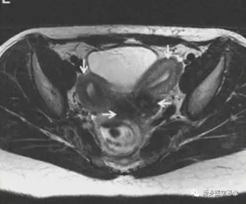 子宫发育异常，应想到的6大类常见畸形