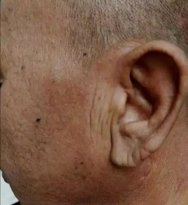 肝硬化早期常见的七种症状都没有,怎样确诊肝硬化已经到了晚期