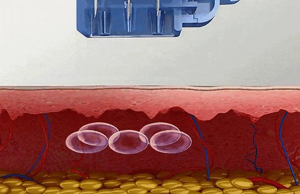 关于水光针的这几大误区，哪一条最终欺骗了你？