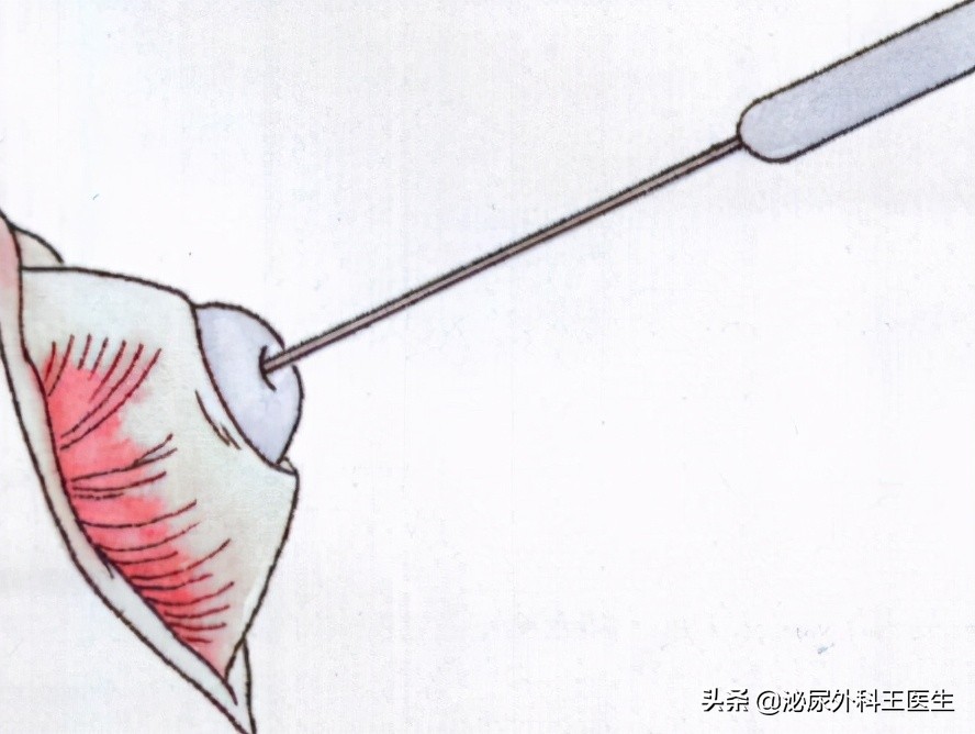 男性做了结扎要注意什么,男性做了结扎会自动复原吗