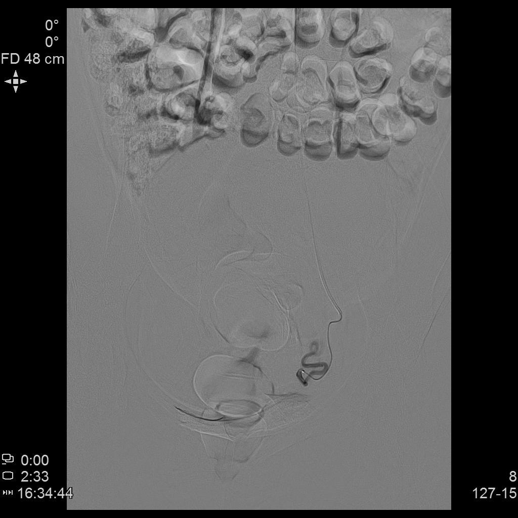 子宫肌瘤的位置、大小对介入栓塞疗效有何影响？