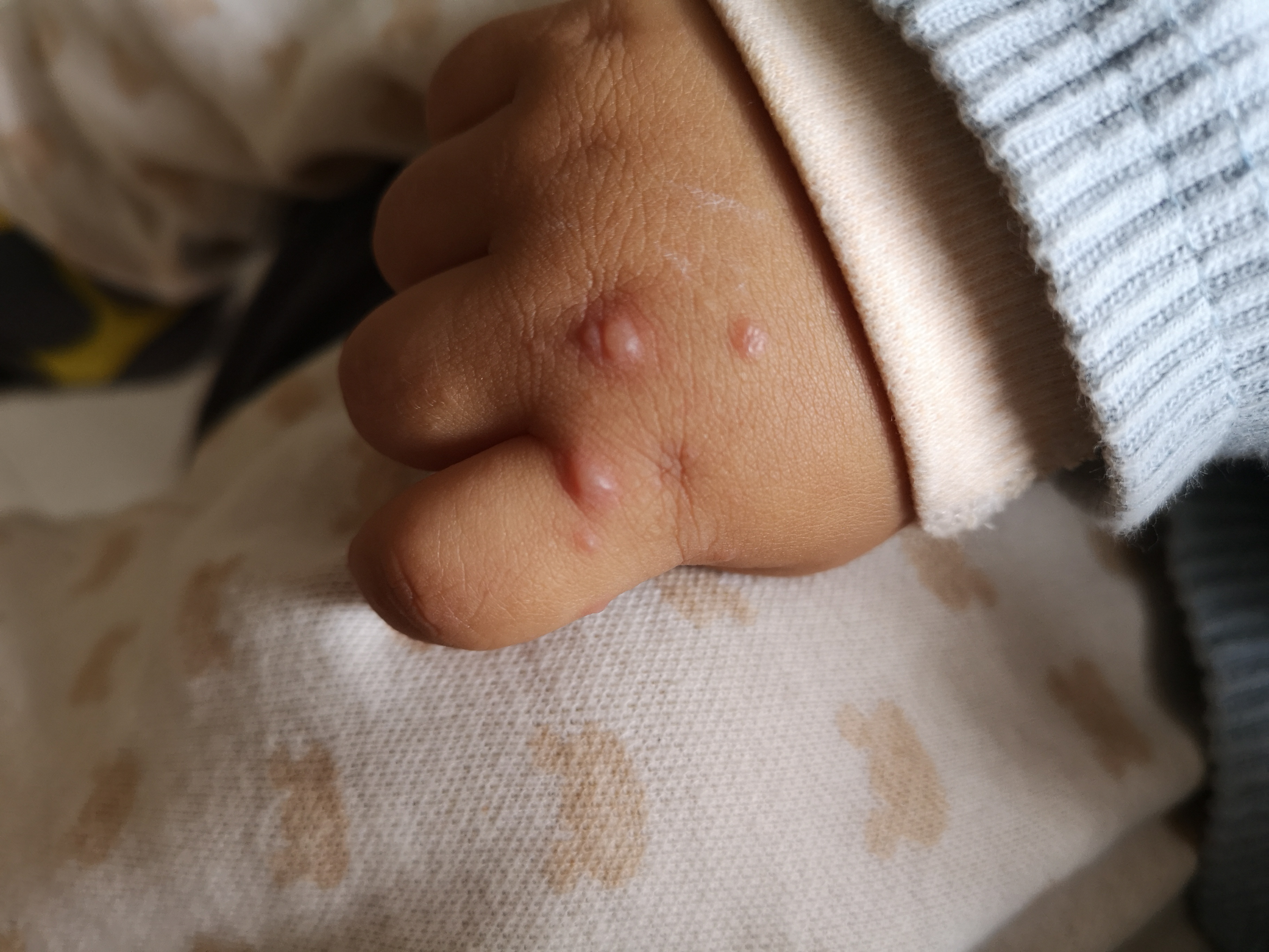 手足口病毒高发期,手足口高发期温馨提示