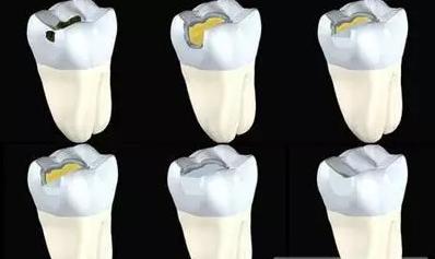 牙齿龋坏究竟要怎么办，补牙之后又能用多久呢？听听看牙医怎么说